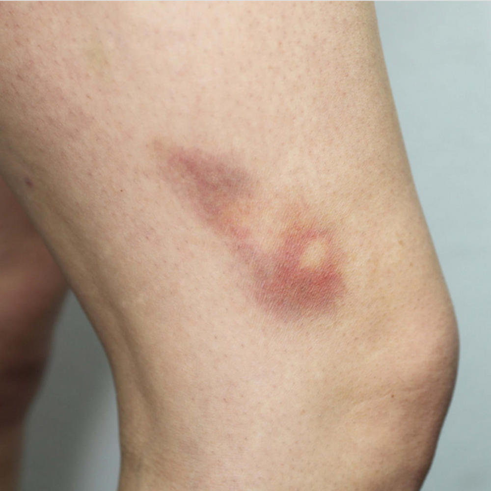Temporary Tattoos Bruises 2B