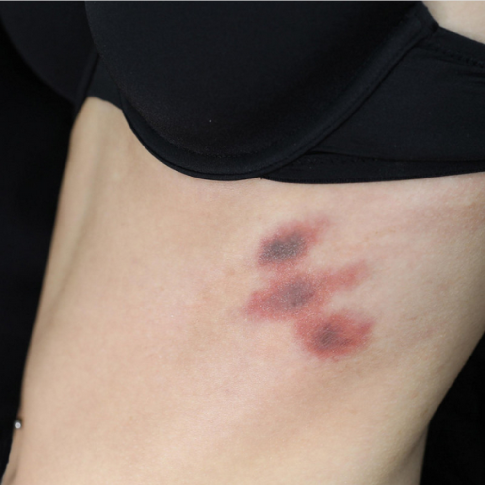 Temporary Tattoos Bruises 2B