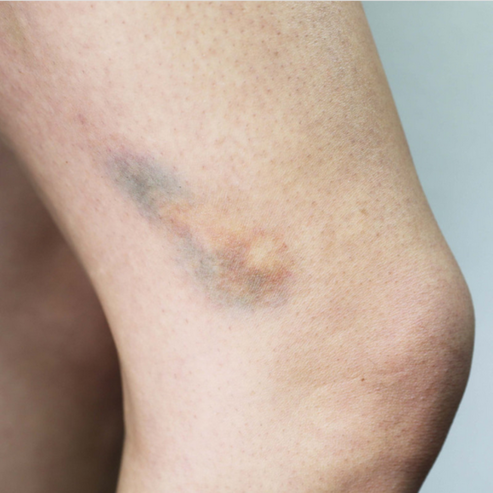 Twilight Creations Tattoo Bruises 2C